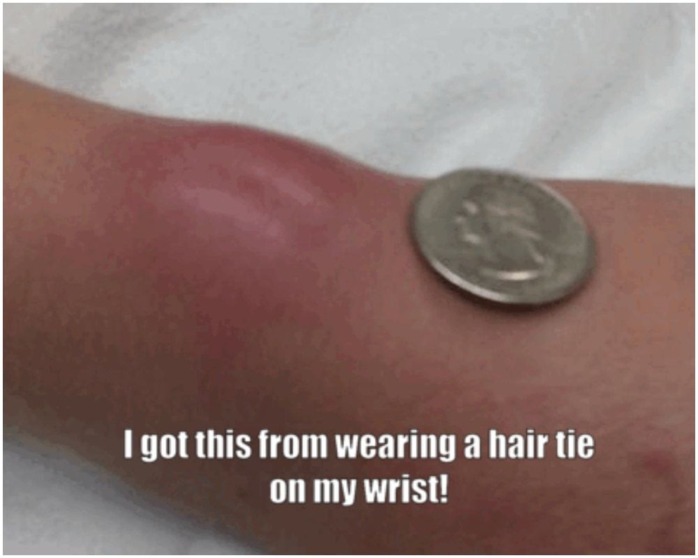 Angered by an Abscess