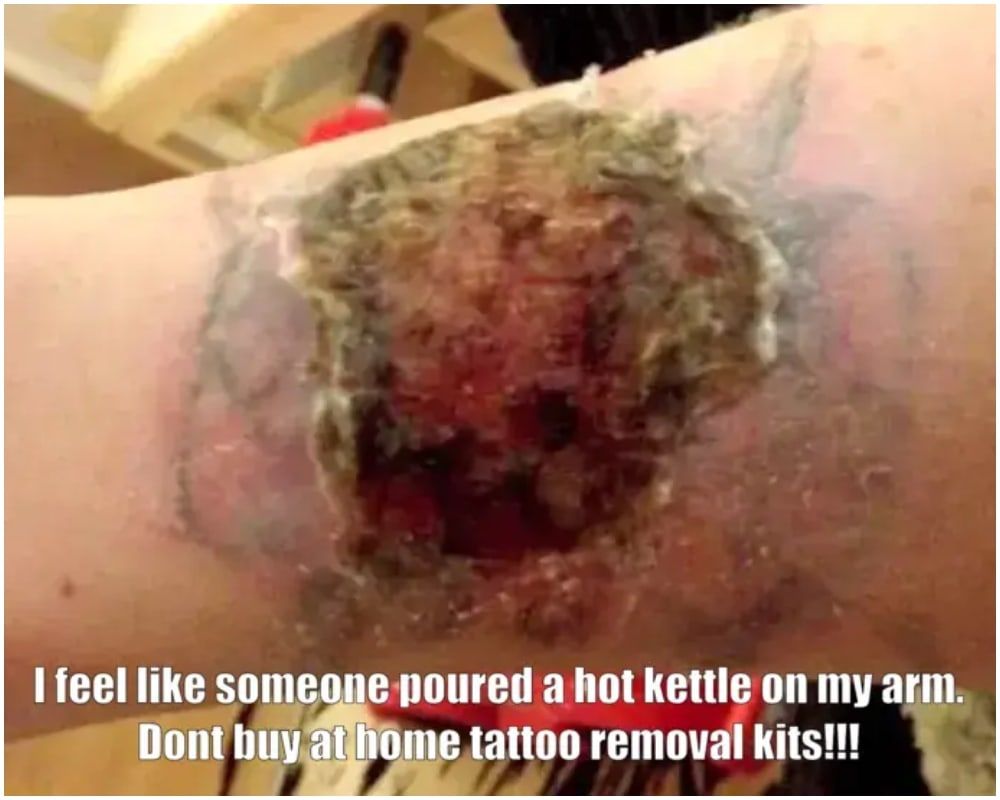 Terrible Tattoo Removal Kits