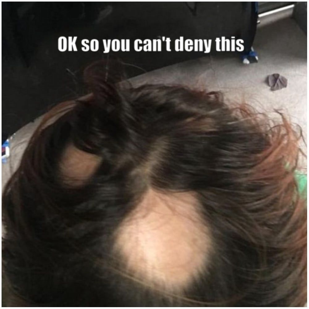 Patch Test or Bald Patches